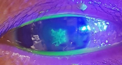 Viêm giác mạc do virus Herpes — Đừng chủ quan, có thể gây mù lòa nếu chậm trễ