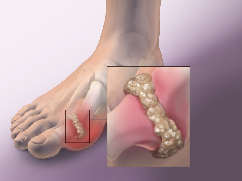 BỆNH GOUT – ĐỪNG CHỦ QUAN VỚI NHỮNG CƠN ĐAU KHỚP