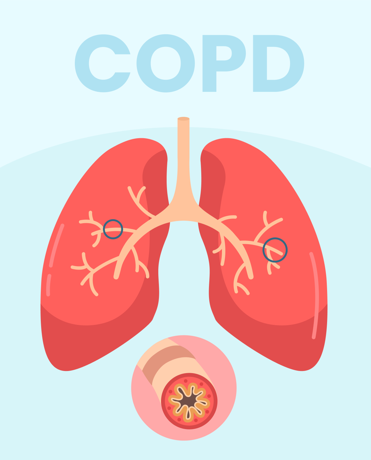 🫁 HƠI THỞ KHÓ KHĂN? COI CHỪNG COPD!