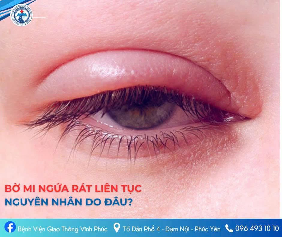 BỜ MI LÀ GÌ? VÌ SAO MẮT BẠN CỨ NGỨA RÁT, KHÓ CHỊU KÉO DÀI?