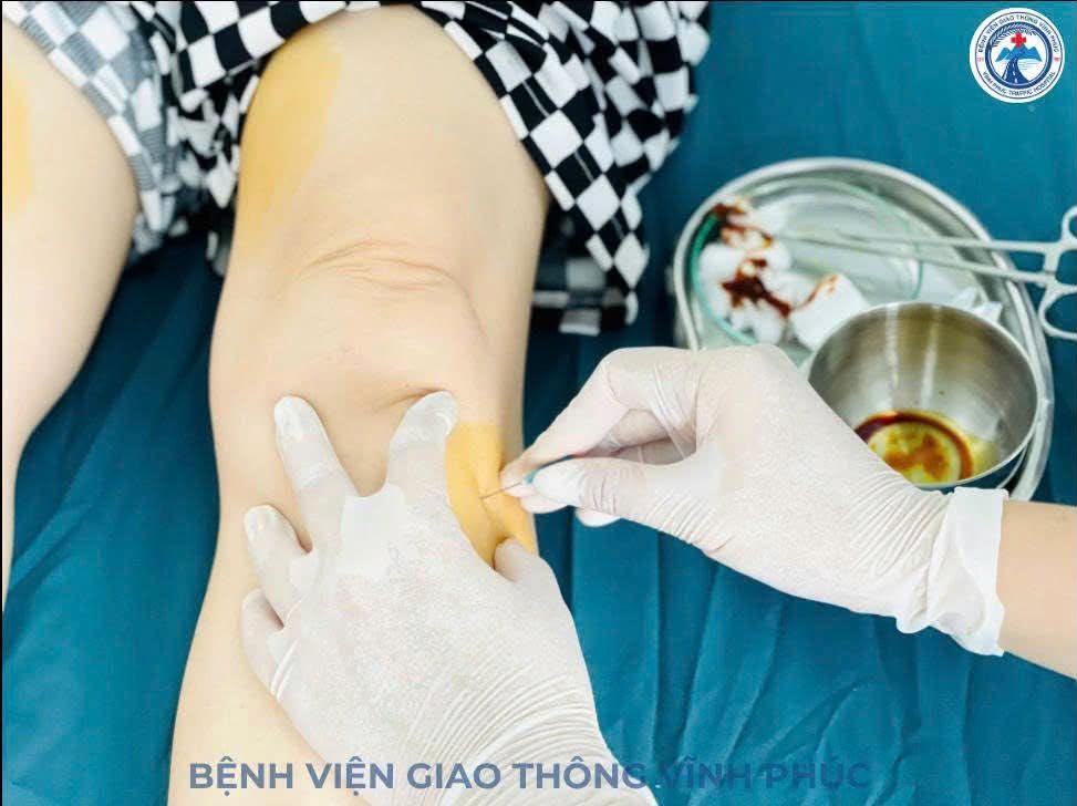 ƯU ĐIỂM VÀ NHƯỢC ĐIỂM CỦA PHƯƠNG PHÁP CẤY CHỈ